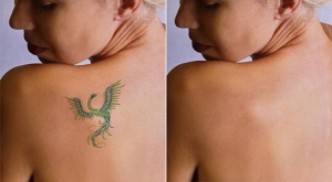 Renew, Remove, Relive: The Laser Tattoo Removal Revolution